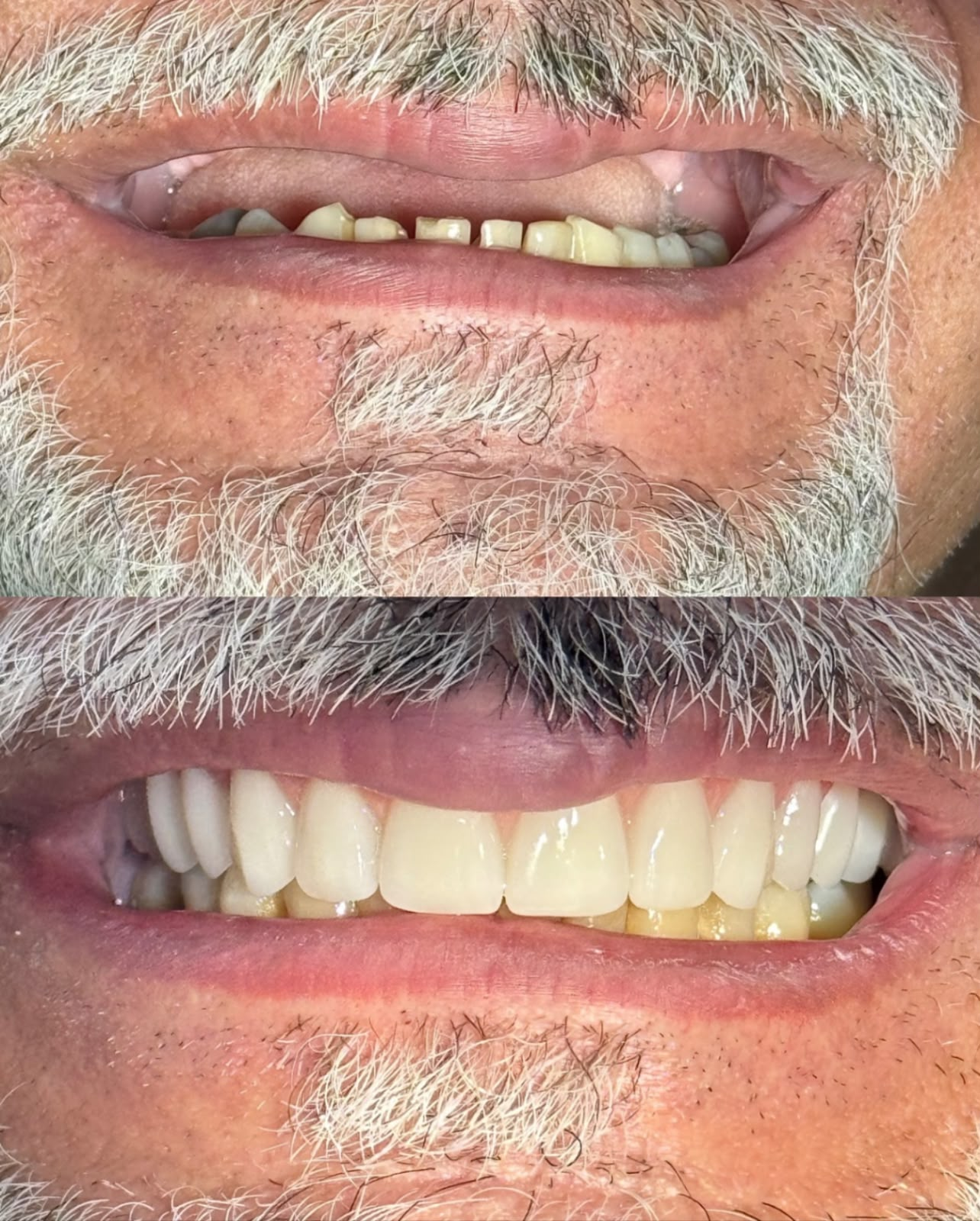 Antes e depois de reabilitação do sorriso realizado na OdontoMed